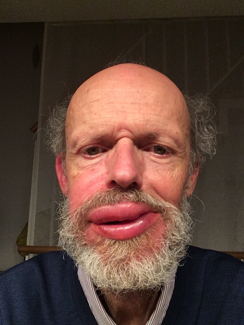 dicke Lippe nach Stich