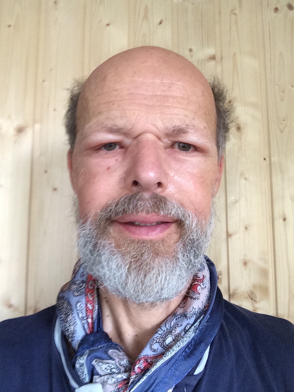 wegen Bienenstichen geschwollenes
Gesicht